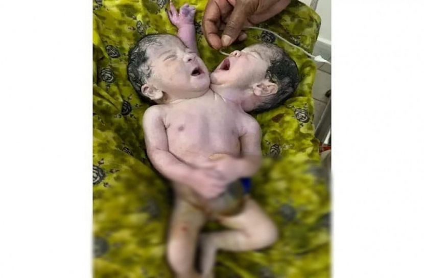 দুই মাথাওয়ালা শিশুর মৃত্যু
