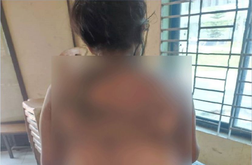 হিজড়াকে গায়ে কেরোসিন ঢেলে আগুন, আটক ৩