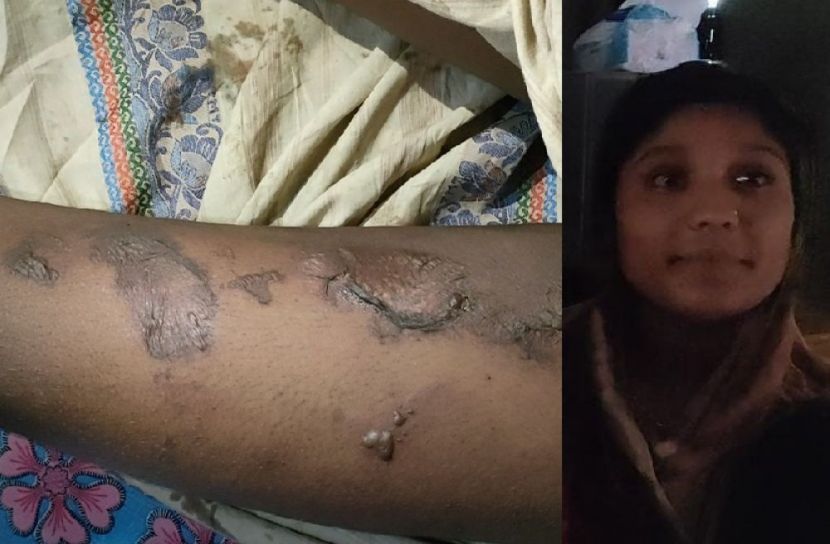 গরম পানিতে শিশুকে ঝলসে দেওয়ায় তরুণী গ্রেফতার