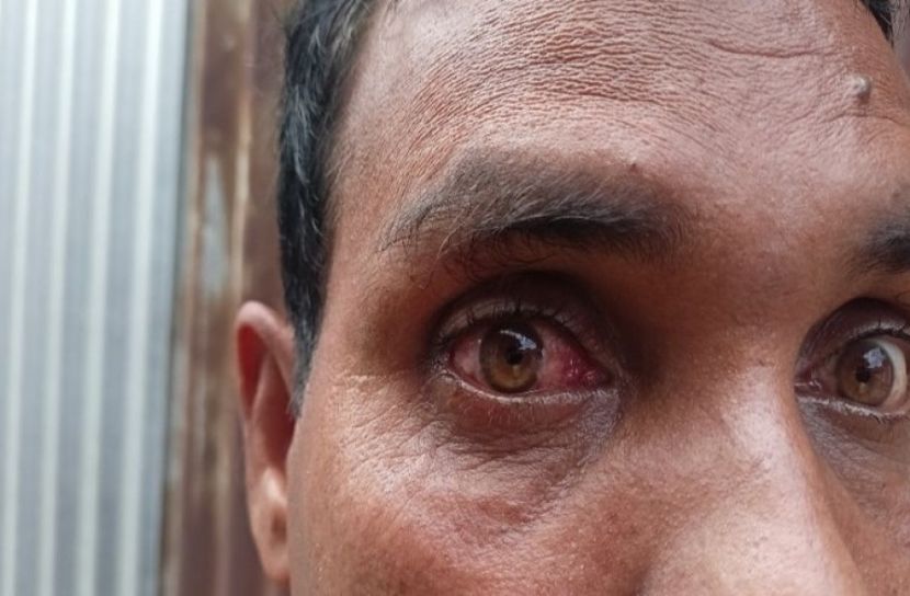 হঠাৎ বেড়েছে চোখ ওঠা রোগ, ড্রপ সংকট